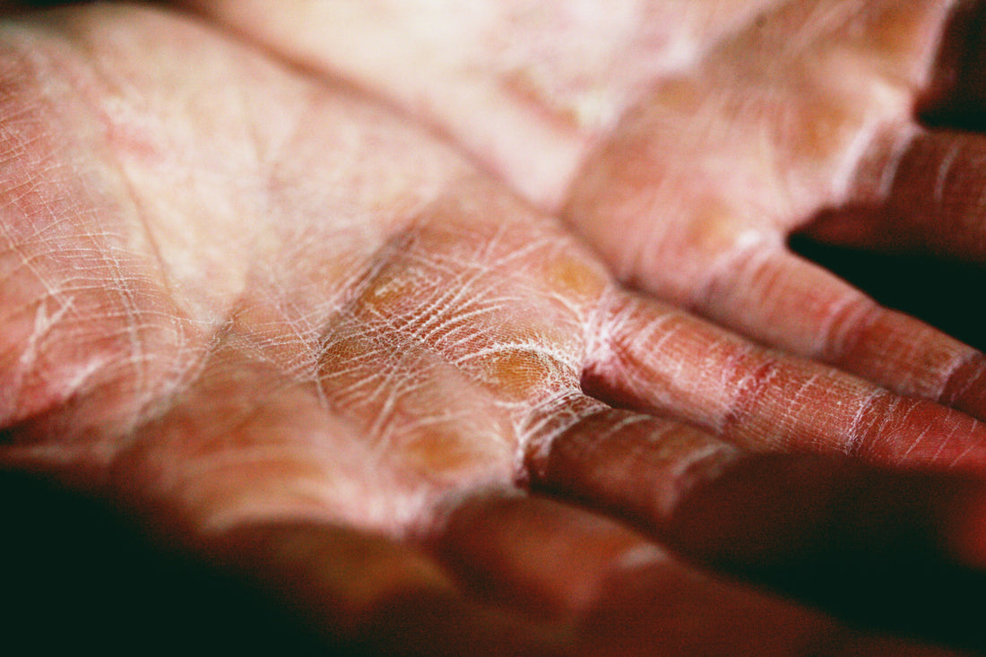 Understanding Your Skin Barrier: Why Your Skin Stays Dry (and How to Support It Naturally)